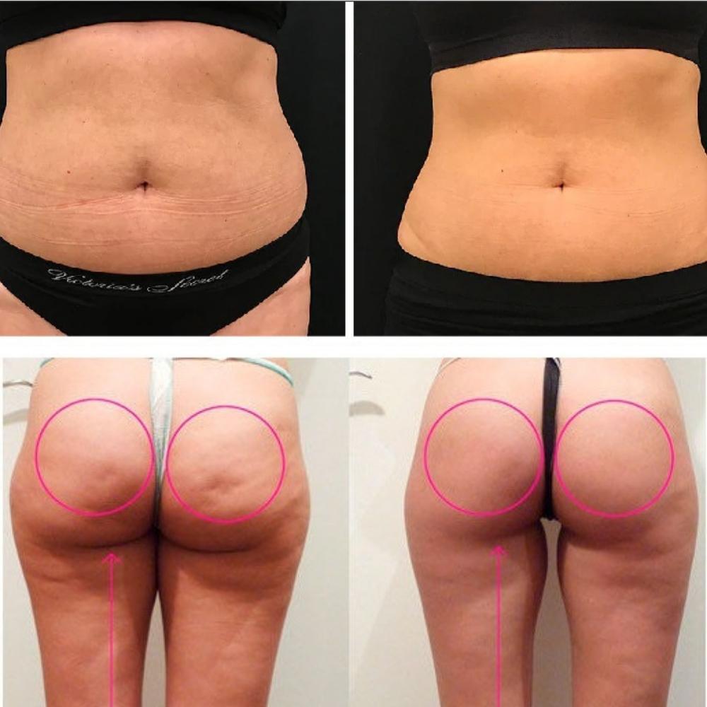 LipoPower - Non-Surgical Liposuction